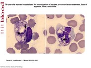 Killers on the road: Klebsiella and Pseudomonas bacteremia detected on peripheral blood smear