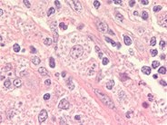 Histoplasmosis