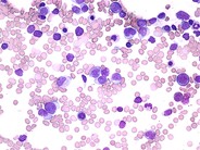 acute-myeloid-leukemia-with-multilineage-dysplasia-3