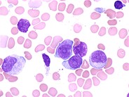 Acute Myeloid Leukemia with Multilineage Dysplasia - 4.