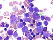 Acute Myeloid Leukemia with Multilineage Dysplasia - 5.