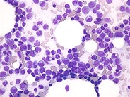 Chronic Myelomonocytic Leukemia - 1.