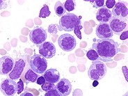 Chronic Myelomonocytic Leukemia - 4.