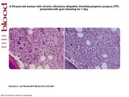 Romiplostim-induced myelofibrosis