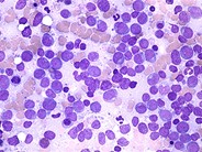 Acute Myeloid Leukemia without Maturation 1.
