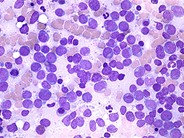 acute-myeloid-leukemia-without-maturation-1