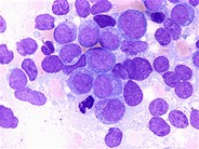 Acute Myeloid Leukemia without Maturation - 3.