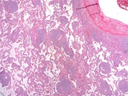 MALT Lymphoma, Lung - 1.