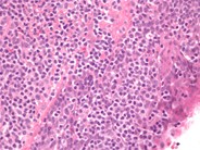 MALT Lymphoma, Lung - 2.