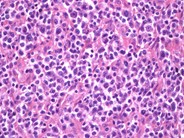 Peripheral T Cell Lymphoma, NOS - 1.