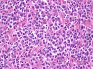 Peripheral T Cell Lymphoma, NOS - 1.