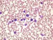 Ph+ Acute Lymphoblastic Leukemia - 1.