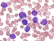 Ph+ Acute Lymphoblastic Leukemia - 2.