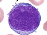Ph+ Acute Lymphoblastic Leukemia - 4.