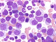 Atypical CML - 2.