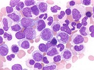 Atypical CML - 3.