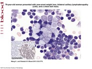 Metastatic Merkel cell carcinoma involving the bone marrow with chronic lymphocytic leukemia mimicking Richter transformation