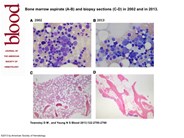 Paroxysmal nocturnal hemoglobinuria and its complications