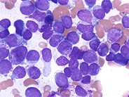 Acute Myeloblastic Leukemia With Maturation - 1.