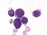 Precursor T-cell Acute Lymphoblastic Leukemia - 3.