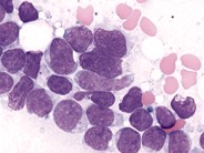 Precursor T-cell Acute Lymphoblastic Leukemia - 6.