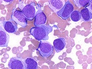 Acute Monocytic Leukemia - 2.