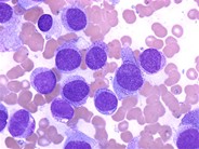 Acute Monocytic Leukemia - 3.