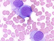 Acute Monocytic Leukemia - 4.