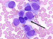 Acute Monocytic Leukemia - 5.