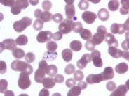 Plasmodium Vivax - 2.