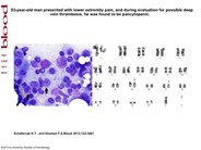 Simultaneous presentation of plasma cell myeloma and acute promyelocytic leukemia