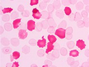 Kleihauer-Betke Hemoglobin F Acid Resistance - 1.