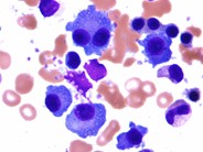 Plasma Cell Inclusions - 1.