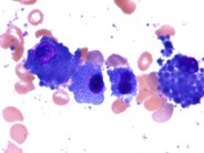 Plasma Cell Inclusions - 3.