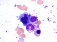 Plasma Cell Inclusions - 5.