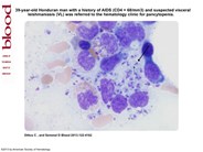 Leishmania amastigotes visualized on bone marrow aspirate in a leishmaniasis and HIV coinfected patient presenting with pancytopenia