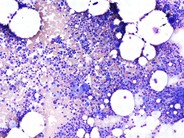 Multiple Myeloma - Large Plasma Cells - 1.