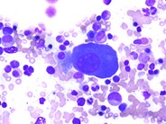 Multiple Myeloma - Large Plasma Cells - 4.