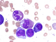 AML with inv(16) - 5.