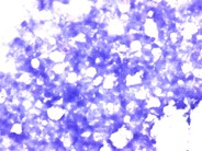 Bone Marrow Necrosis - 1.