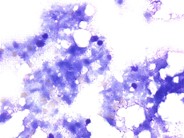 Bone Marrow Necrosis - 2.