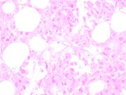 Bone Marrow Necrosis - 4.