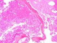 Bone Marrow Necrosis - 5.
