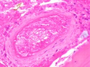 Bone Marrow Necrosis - 8.