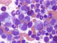 Chronic-Phase-CML--3