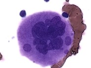 Dysplastic Megakaryocytes - 1.