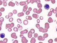 Juvenile Myelomonocytic Leukemia - 6.