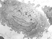 Langerhans Cell Histiocytosis - 4.