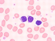 Sézary Cells - 3.