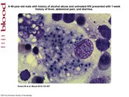 Bone marrow aspirate showing Histoplasma capsulatum